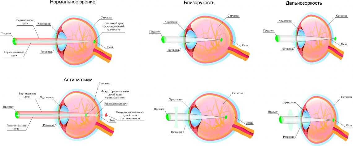Что такое астигматизм и как его лечить: рассказываем простыми словами