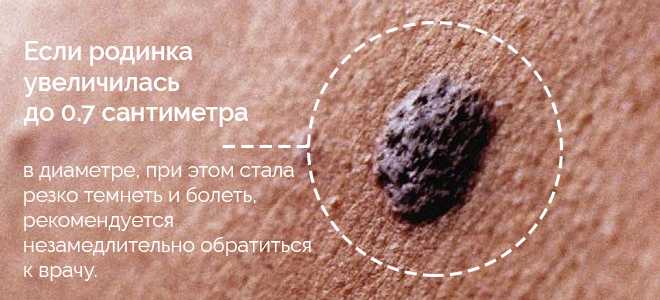 Удаление висячих родинок