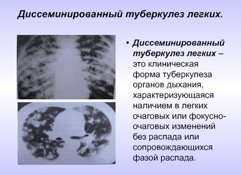 Рентгенологические синдромы туберкулеза и других заболеваний органов дыхания