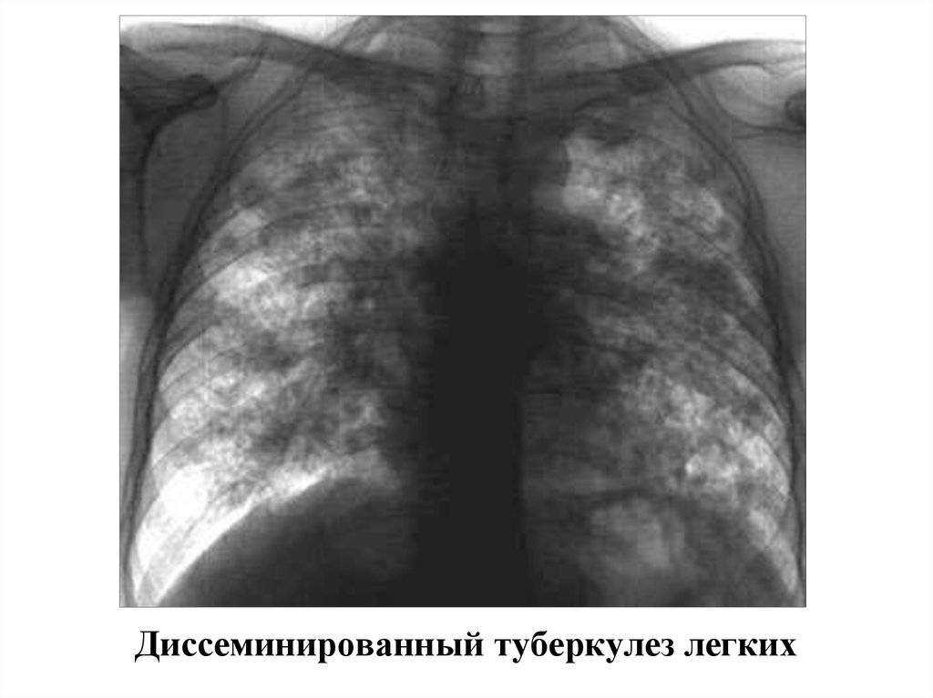 Острый диссеминированный туберкулез. Диссеминированный туберкулез на рентгенограмме. Подострый диссиминированный туберкулёз рентген. Хронический диссеминированный туберкулез легких рентген. Подострый диссеминированный туберкулез рентген.