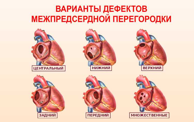 Врожденный порок сердца у новорожденных — классификация, симптомы, лечение