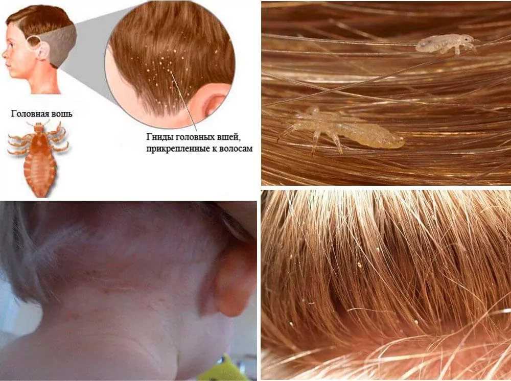Вши у детей: источники заражения и симптомы