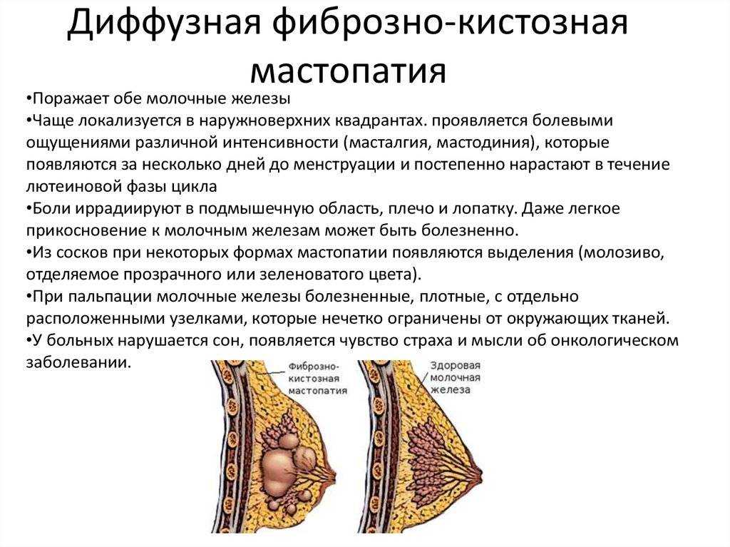 Что такое фкм (фиброзно-кистозная мастопатия молочных желез)? чем лечится?
