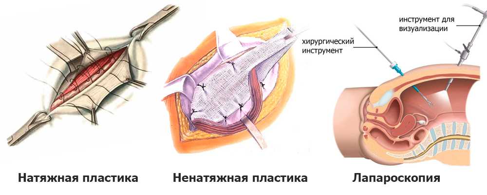 Пупочная грыжа