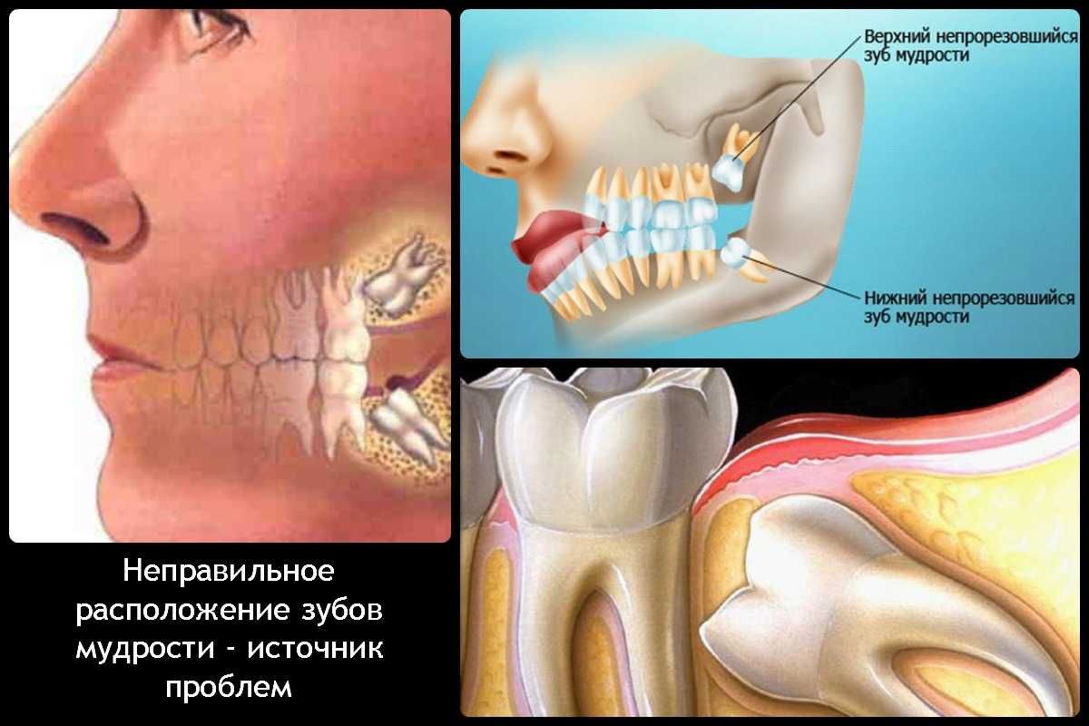 Удаление зуба мудрости | показания, особенности, осложнения