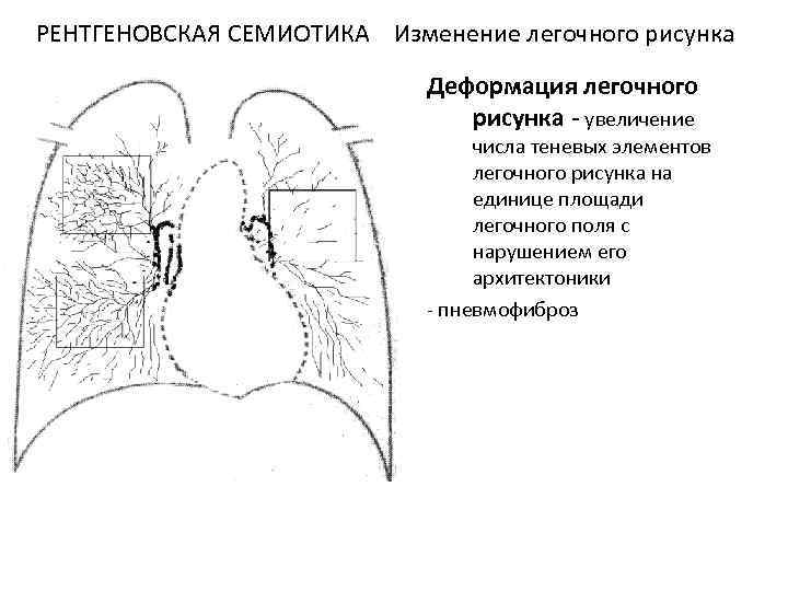 Усиление легочного рисунка на флюорографии: возможные причины, возможные заболевания, отзывы