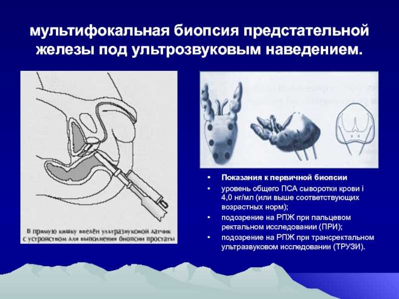 Биопсия предстательной железы