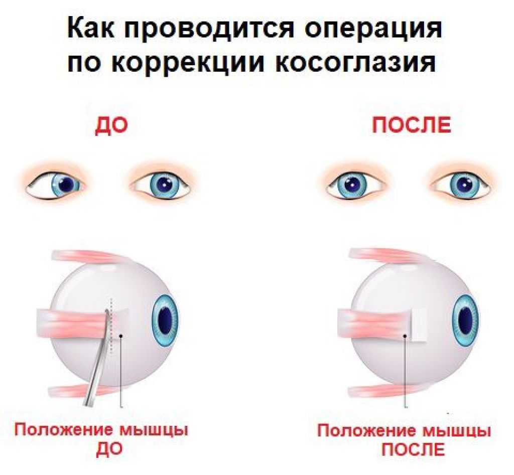 Лазерная блефаропластика — фото до и после