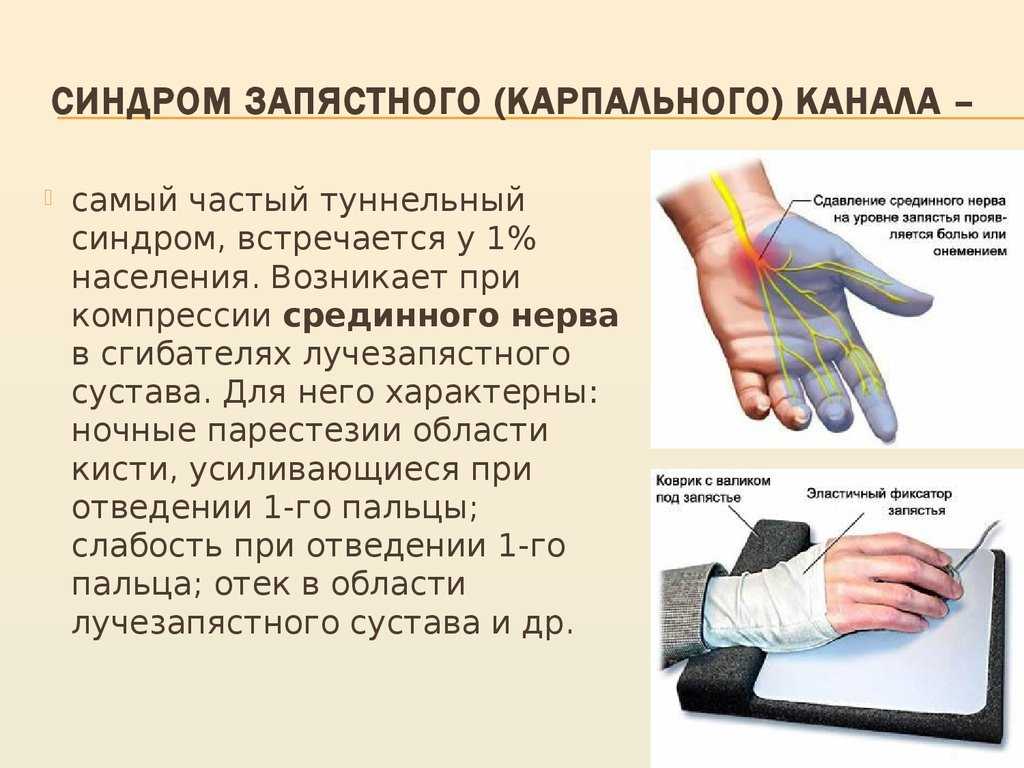 Туннельный синдром