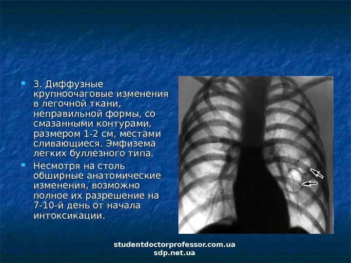 Хобл: что это такое, симптомы и стадии болезни, причины, диагностика, лечение и прогноз жизни