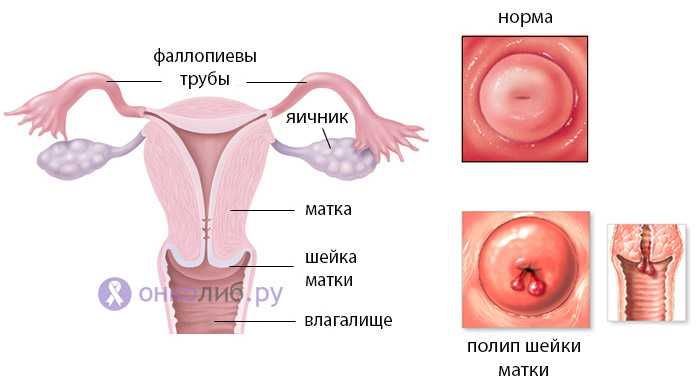 Полип цервикального канала