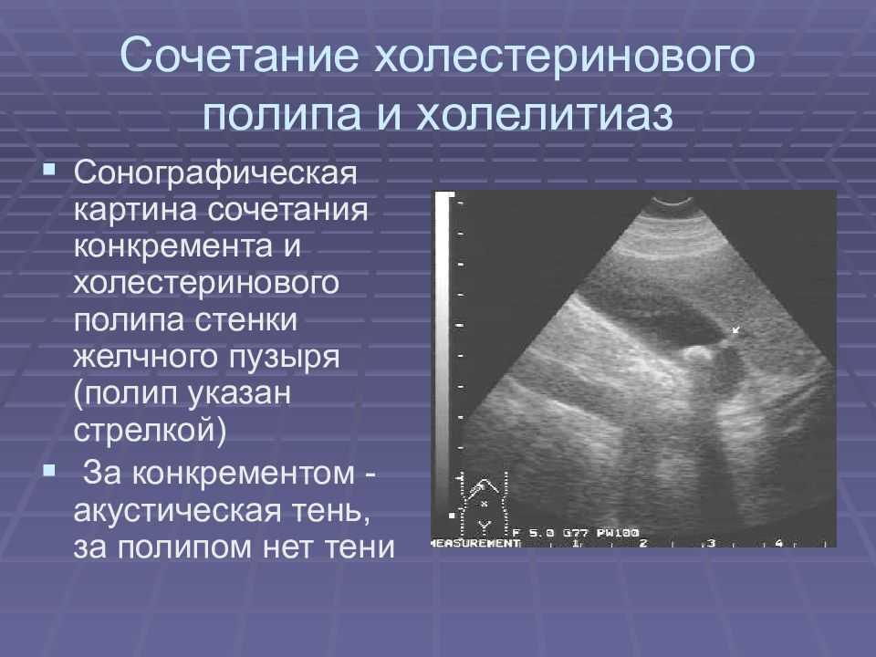 Гиперэхогенные включения в почках без акустических теней - синдром гиперэхогенной почки