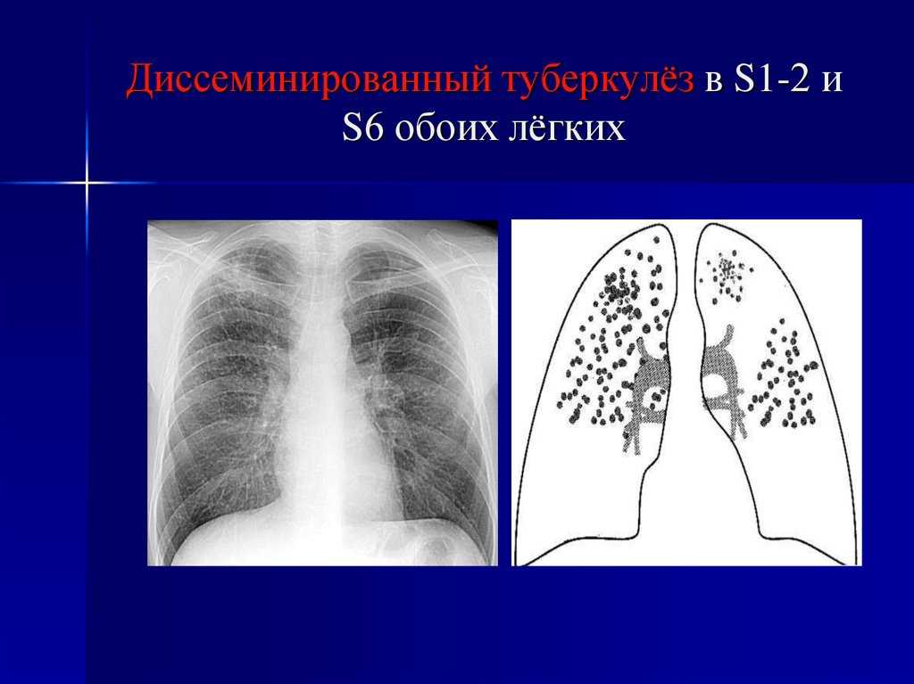 Диссеминированный туберкулез легких картинки