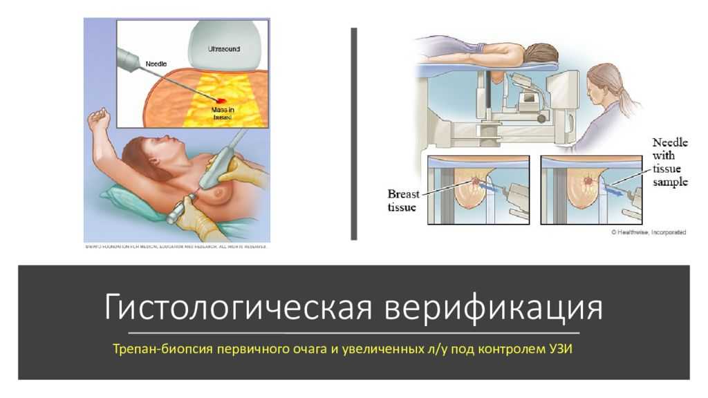 Трепан биопсия. Трепан биопсия молочных желез. Цитологического исследования трепан-биопсия. Трепан-биопсия молочной железы под контролем. Биопсия под контролем рентгена.