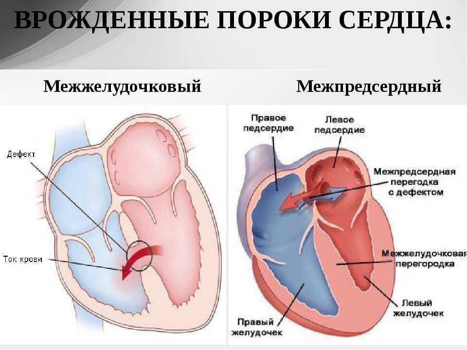 Приобретенные пороки сердца схема