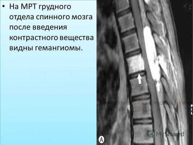 Физические упражнения при гемангиоме позвоночника