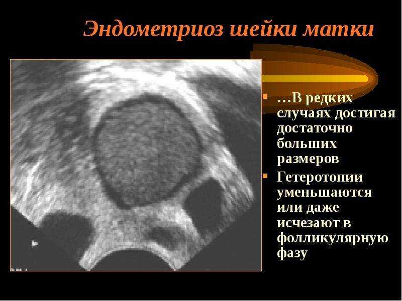 Узел эндометрия. Гетеротопии эндометриоза матки. Эндометриоз шейки матки. Эндометриоз шейки матки на УЗИ.