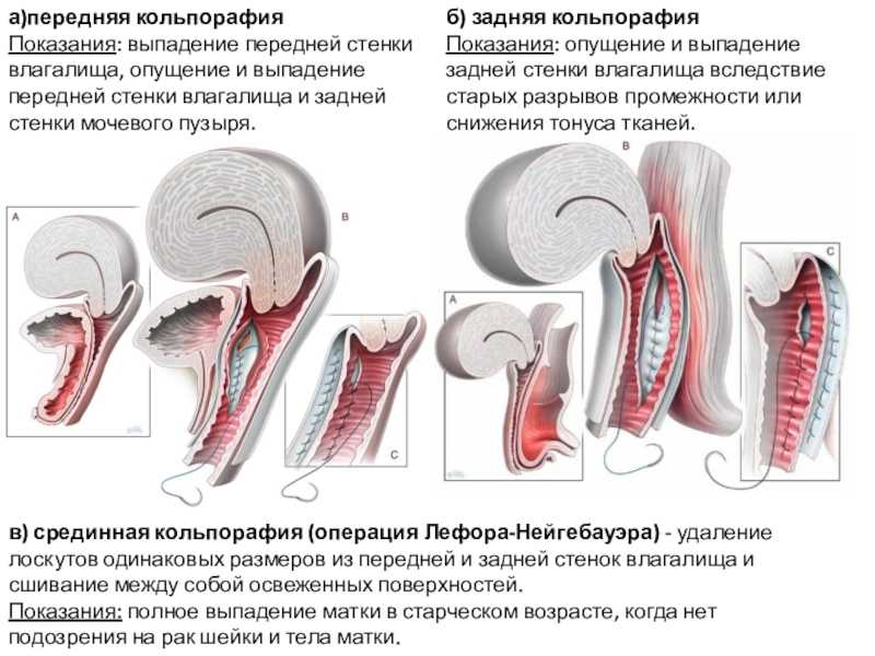 Опущение и выпадение матки: объяснение гинеколога