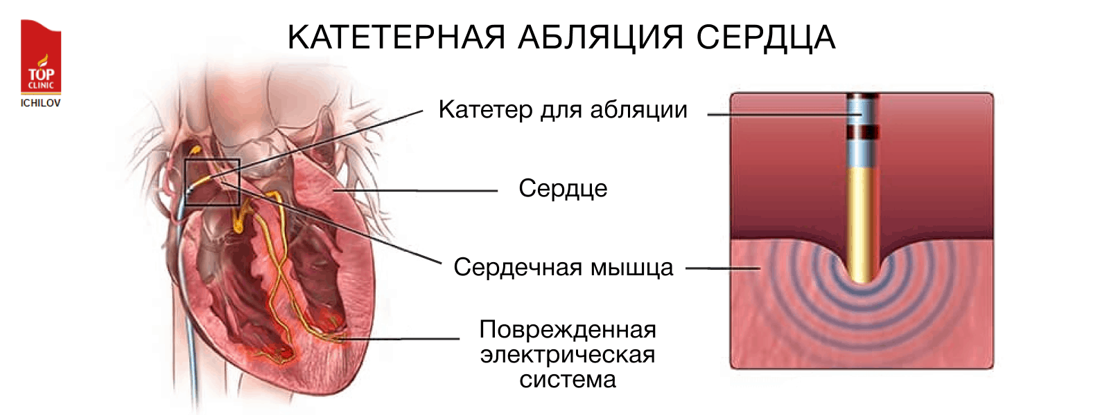 Абляция сердца при мерцательной. Радиочастотная аблация аритмий сердца. Нефлюороскопическая катетерная радиочастотная абляция. Радиочастотная катетерная абляция сердца.