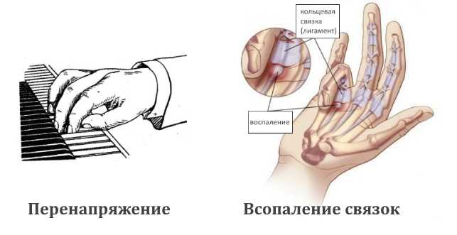 Болезнь нотта что это