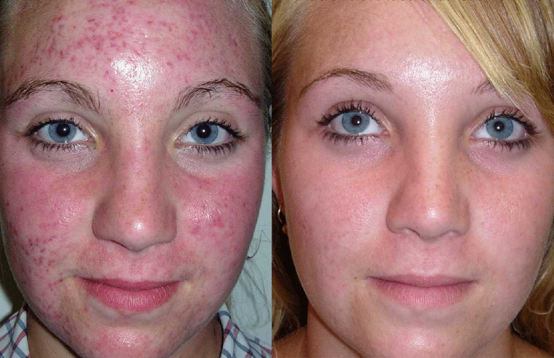 Угри на лице: причины появления и способы лечения акне на лице