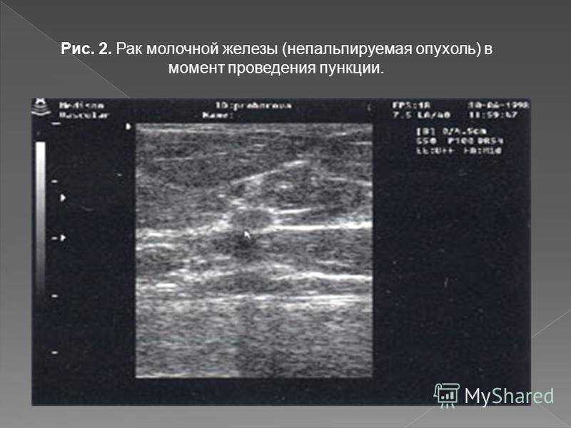 Узи молочных желез выявляет опухоль от 1 мм