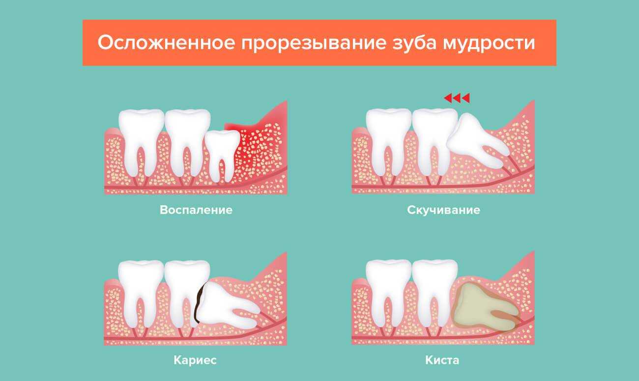 Удаление зубов мудрости - методы и рекомендации