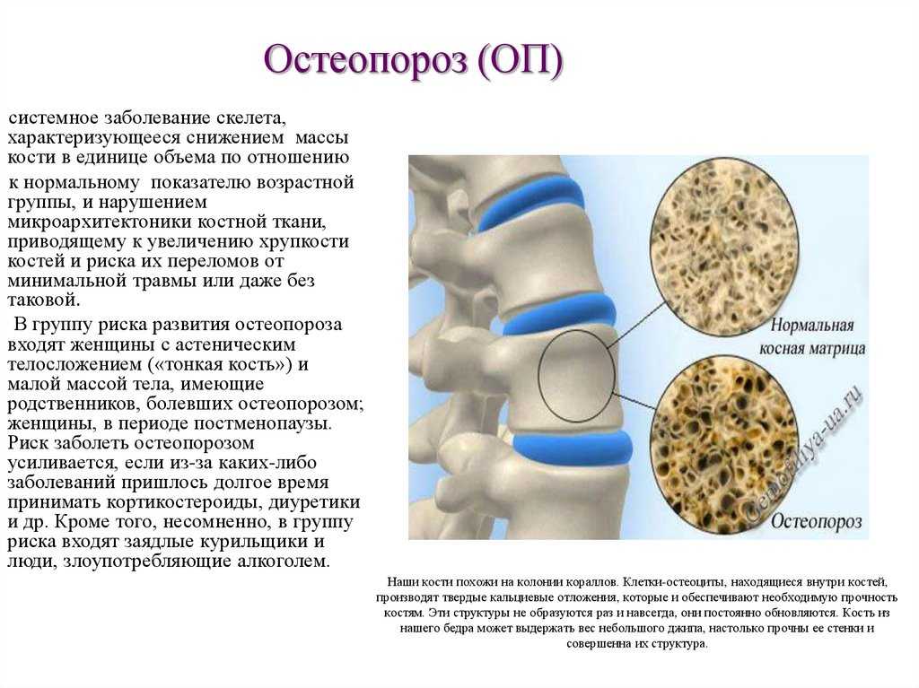 Остеопороз: симптомы, диагностика и лечение остеопороза. как снизить риск переломов: профилактика остеопороза