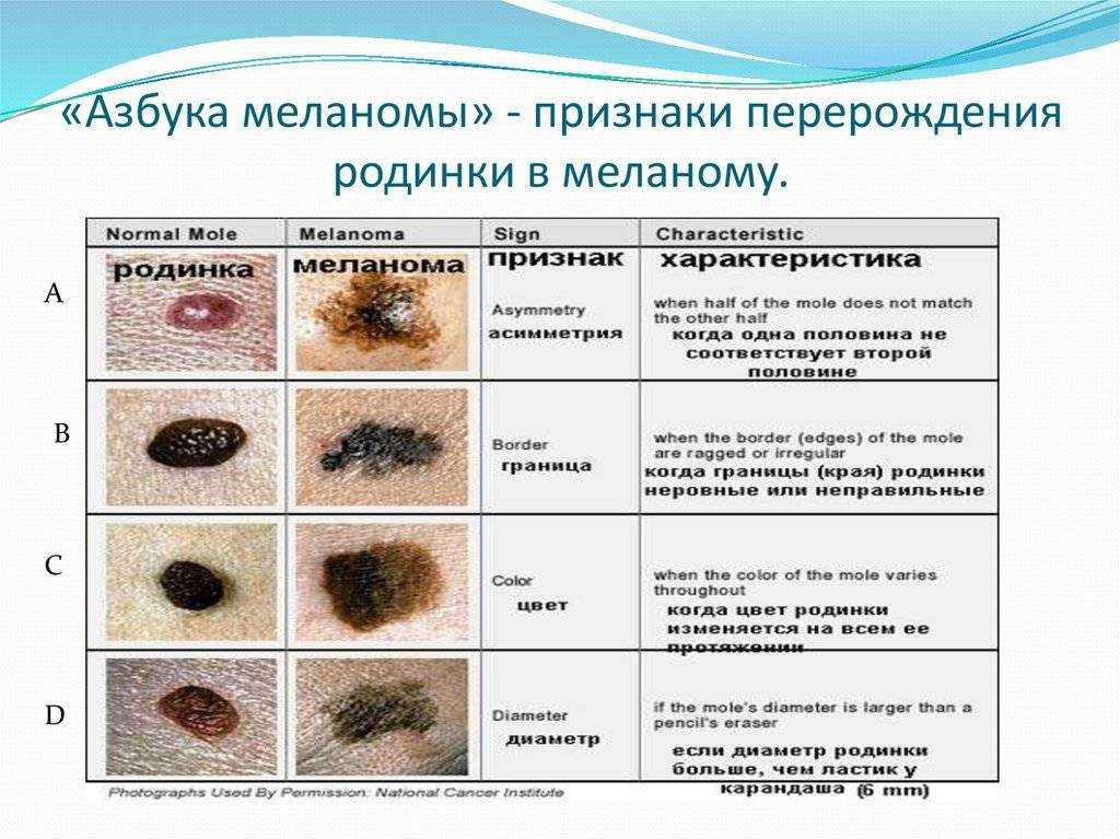 Можно удалять родинку на голове?