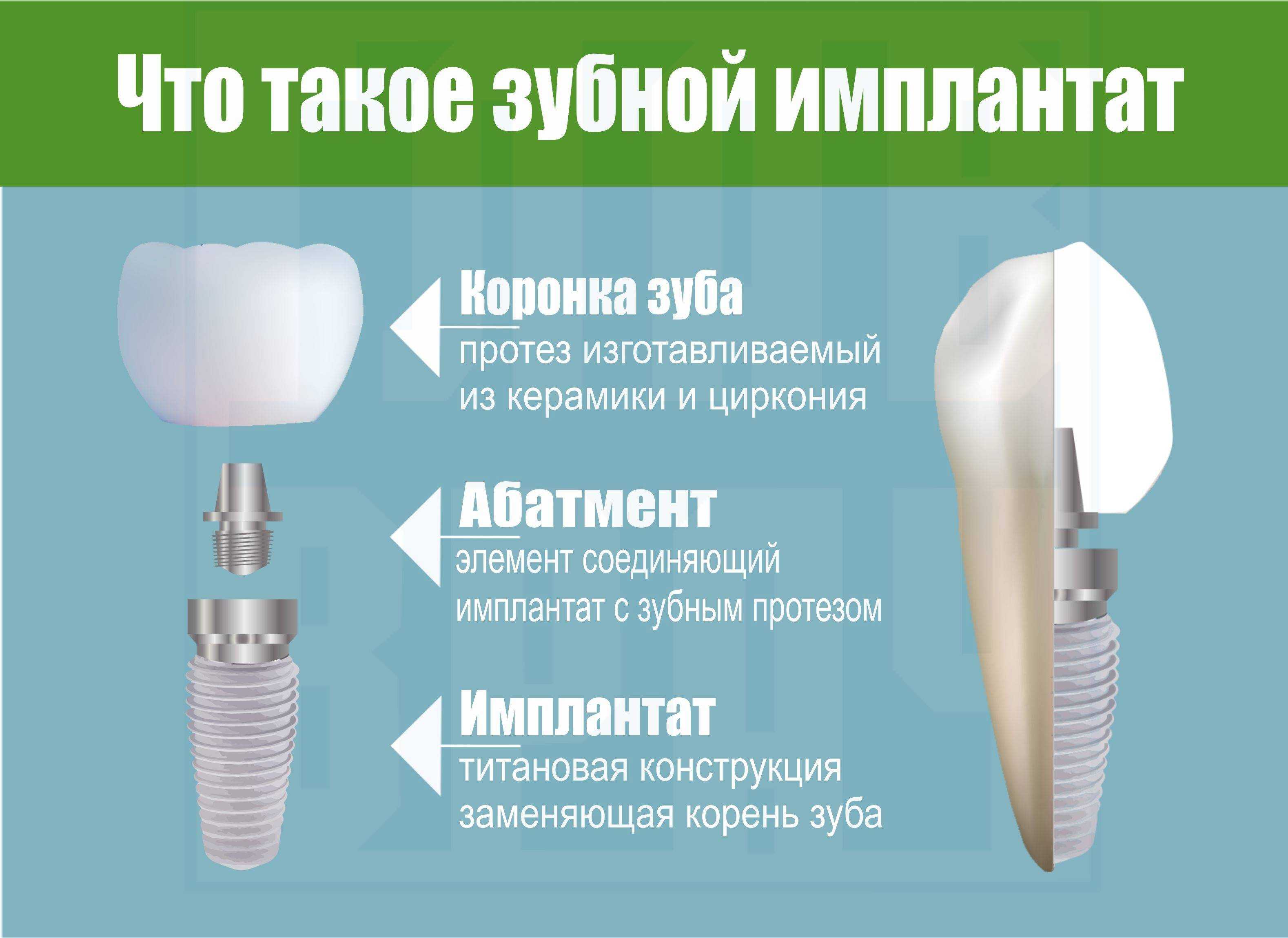 Схема установки имплантов зубов на нижней челюсти