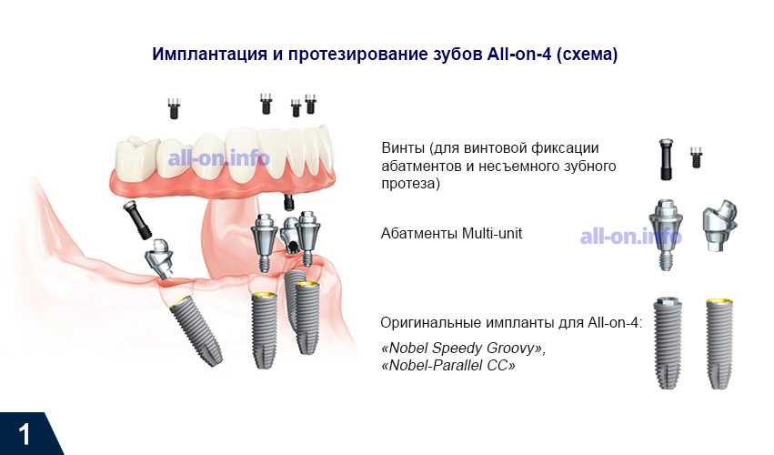 Имплантация схема установки зубов