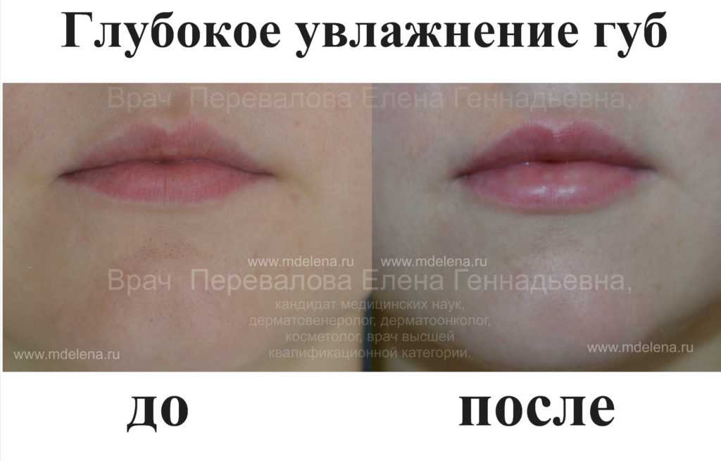 Что нельзя делать после увеличения губ гиалуроновой кислотой
