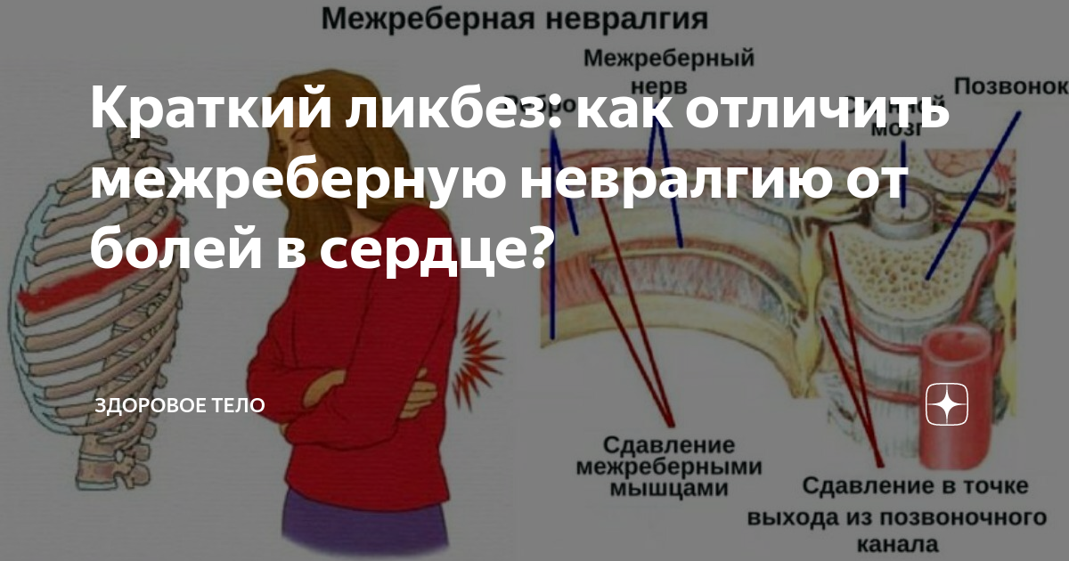 Как отличить боли в сердце от невралгии: симптомы и диагностика