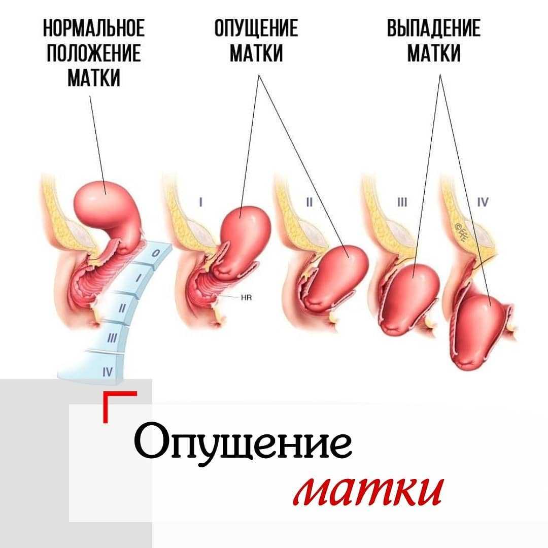 Загиб матки: причины, симптомы, лечение