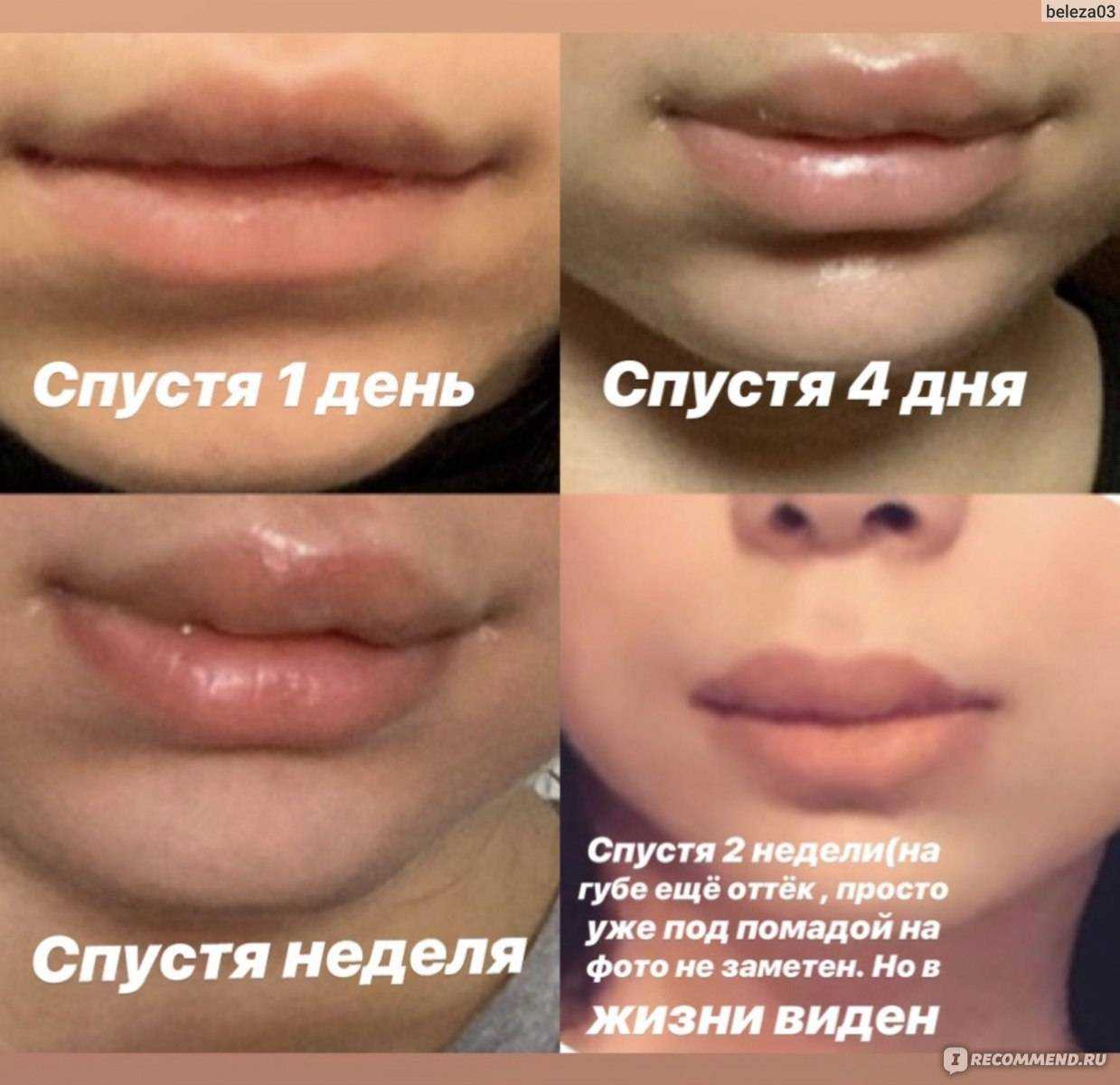 Обезболивание при увеличении губ | часто задаваемые вопросы об инъекционной косметологии