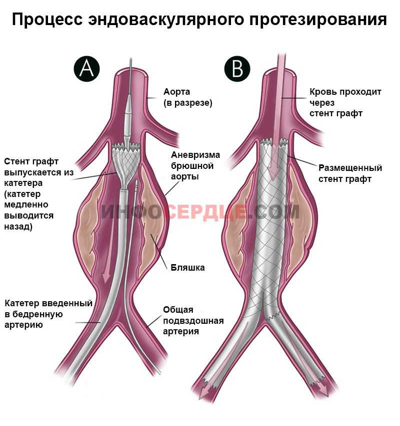 Симптомы, профилактика и лечение аневризмы брюшной аорты - medside.ru