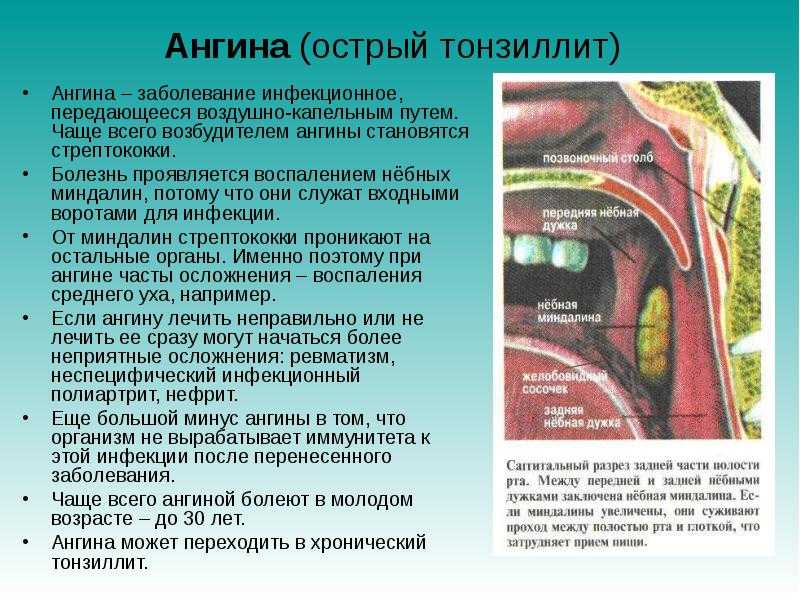 Фолликулярная ангина