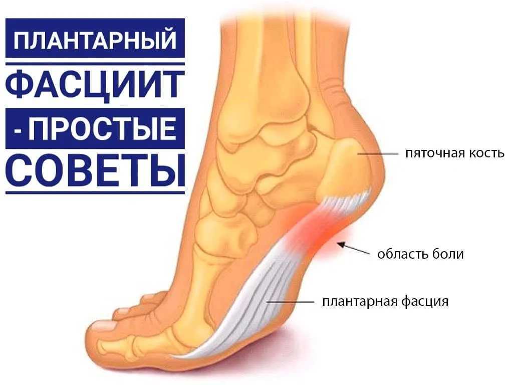 Пяточная шпора ️: симптомы, причины, диагностика и лечение