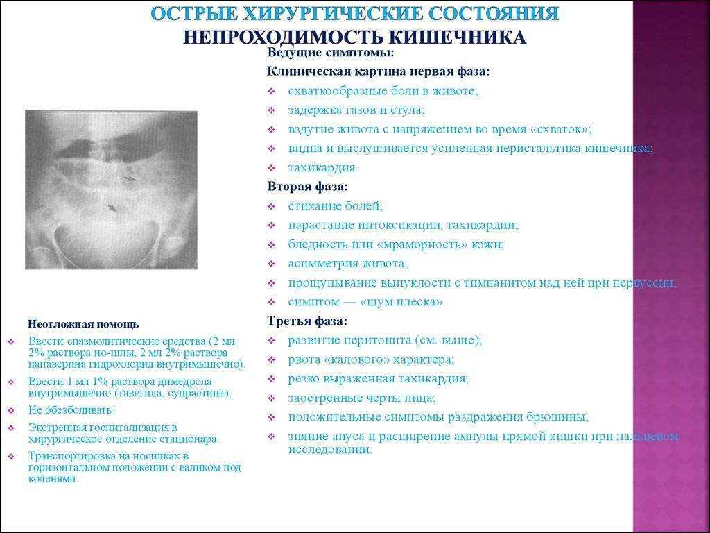 Кишечная непроходимость, симптомы и лечение