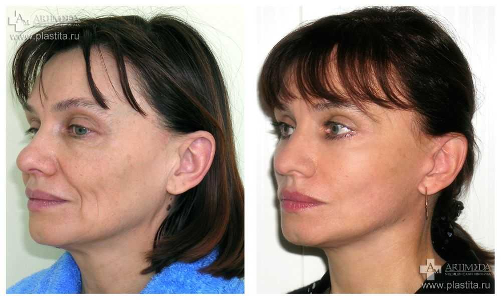 Жирная кожа лица: правильный ежедневный уход | блог expert clinics