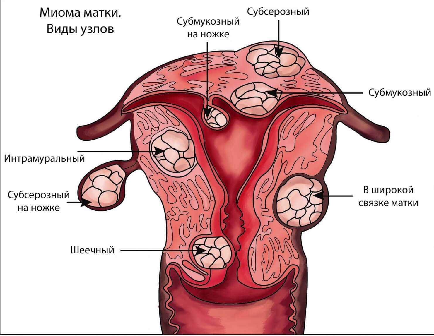 Кровотечение при миоме