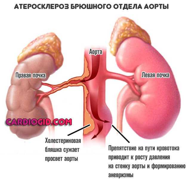 Ишемия почек. Атеросклероз грудного и брюшного отделов аорты. Атеросклероз брюшного отдела аорты. Клинические проявления атеросклероза аорты. Стенозирующий атеросклероз брюшной аорты.