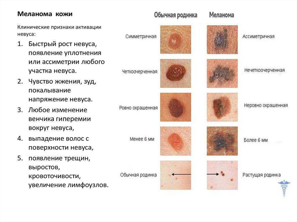 Псориаз и современные методы его лечения