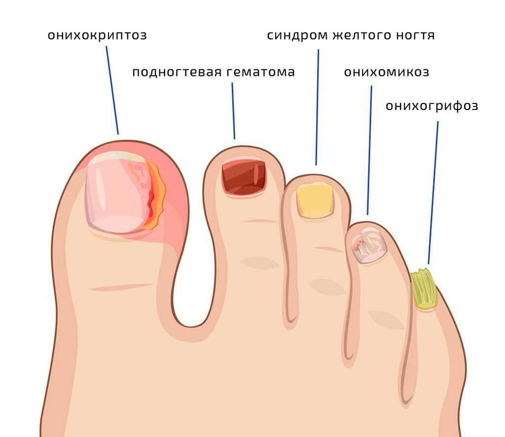 Лечение микоза стоп