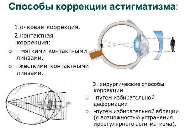 Коррекция астигматизма. Сложная миопия астигматизм. Миопический врожденный астигматизм. Форма роговицы при астигматизме. Сложный прямой гиперметропический астигматизм у детей.