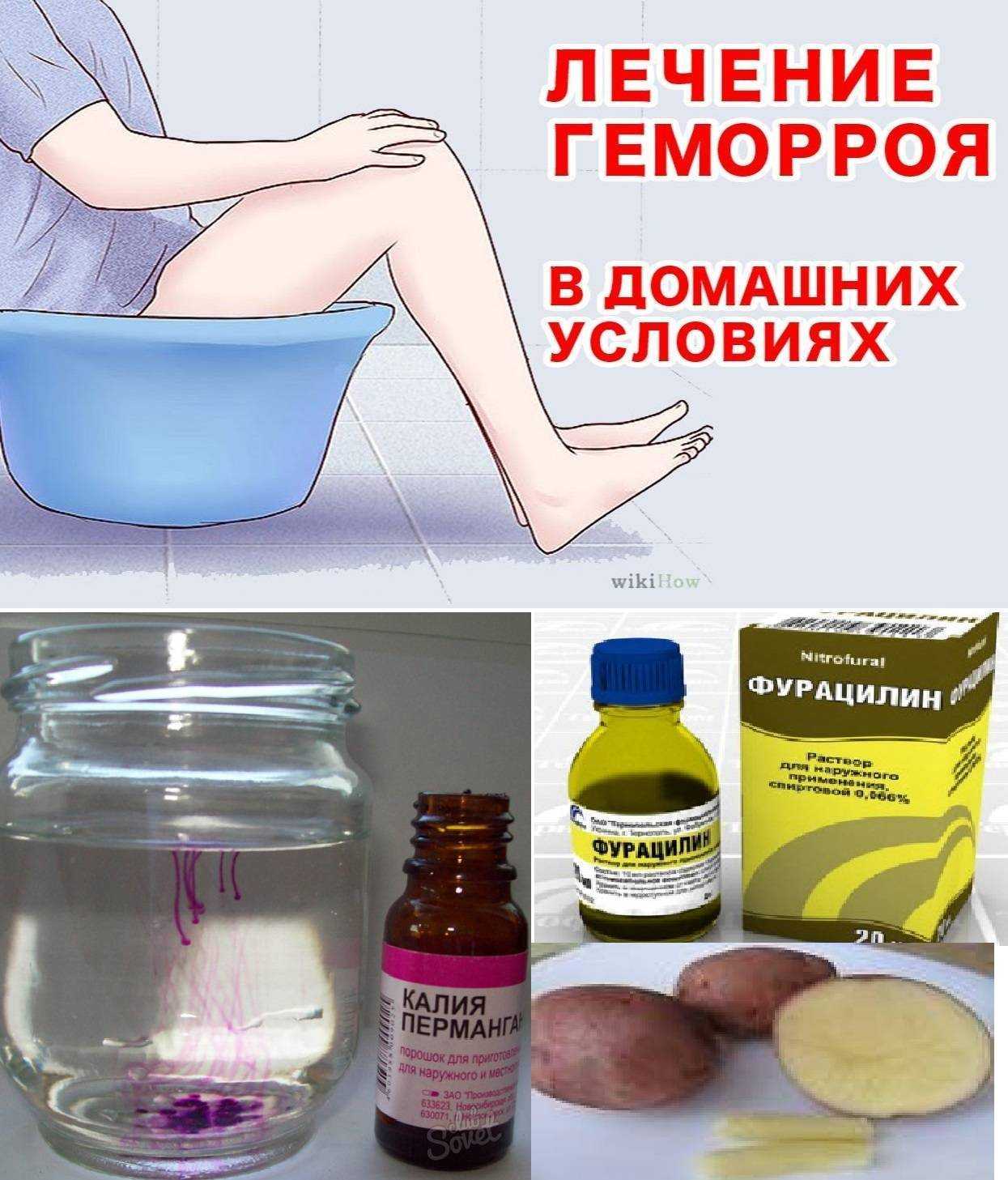 Геморрой