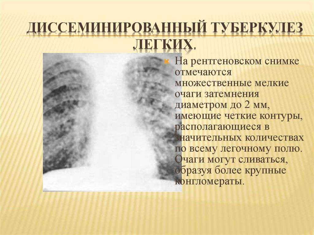 Диссеминированный туберкулез фаза инфильтрации. Милиарный диссеминированный туберкулез рентген. Хронический диссеминированный туберкулез рентгенограмма. Диссеминированный туберкулез легких рентгенограмма. Диссеминированный туберкулез на рентгенограмме.