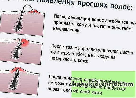 Вросшие волоски: что это такое и как с этим бороться?