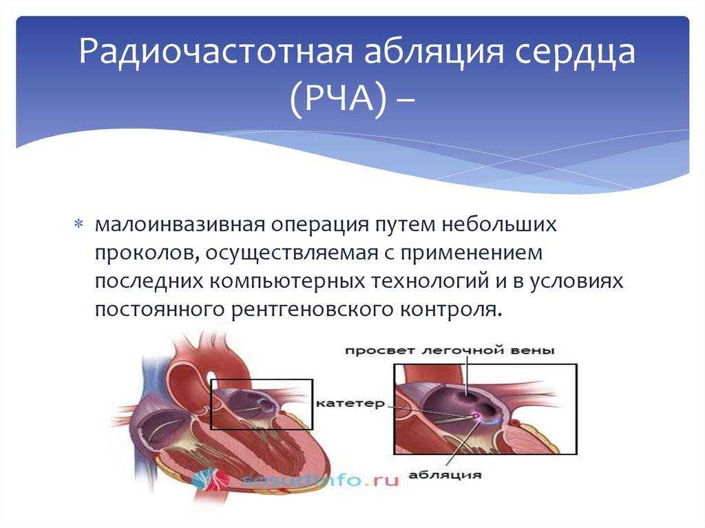 Правила жизни пациентов после операции на открытом сердце (операции коронарного шунтирования) | кардиологический центр в санкт-петербурге