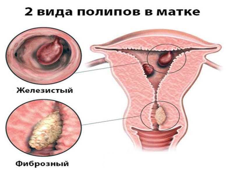 Полипы матки и цервикального канала | санкт-петербург, клиника "неомед", (812) 249-0-249